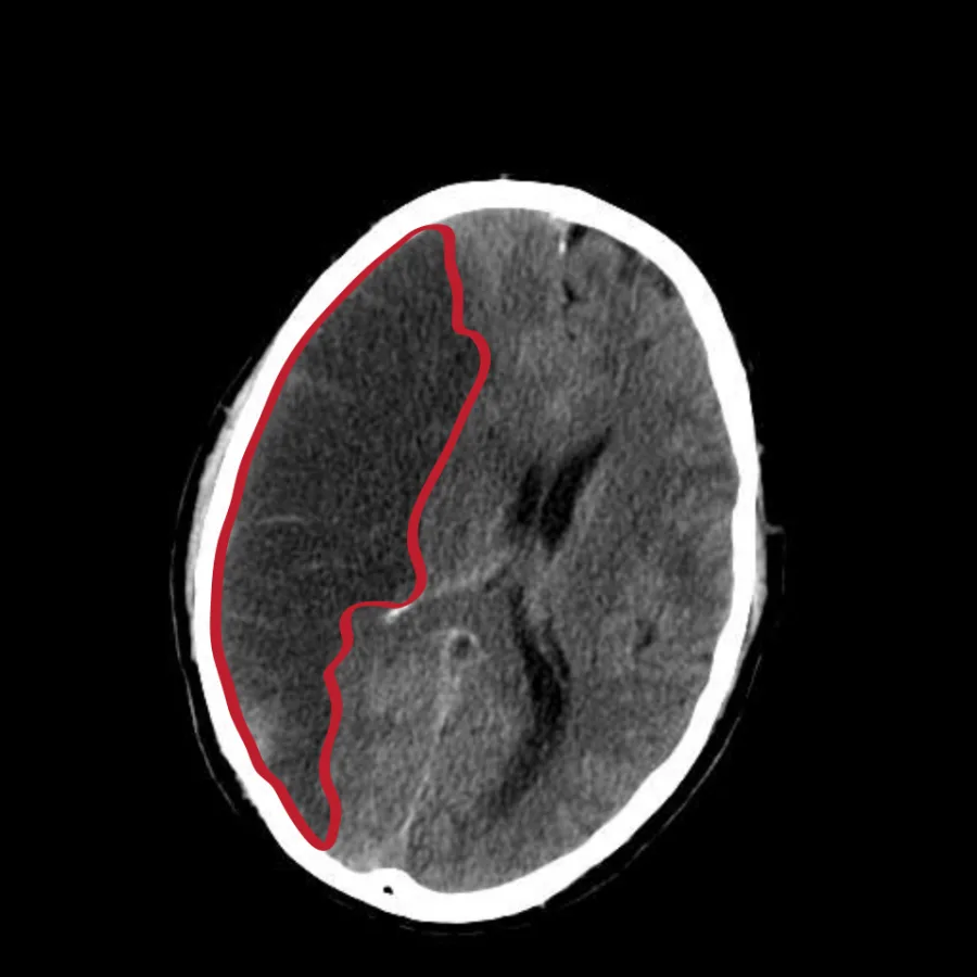 Imagen ilustrativa de Secuelas de infarto cerebral